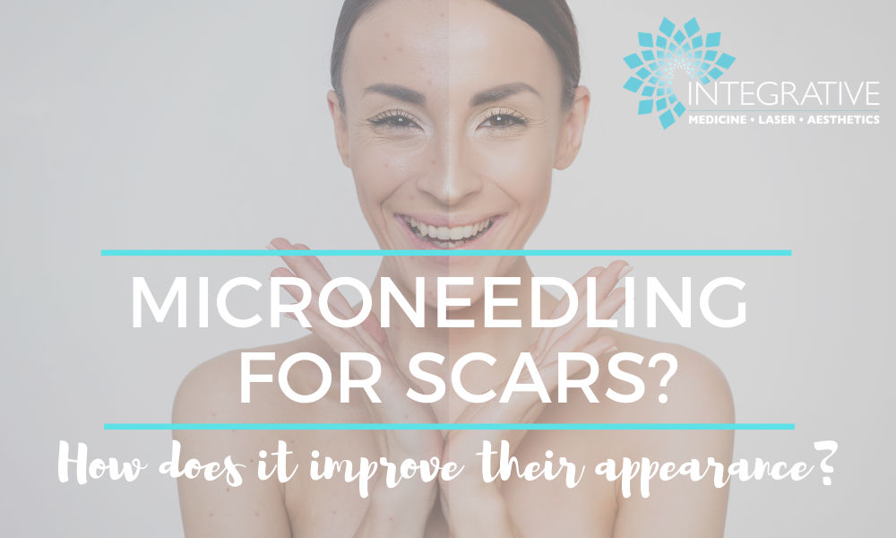 Microneedling for Scars