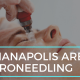Indianapolis Area Microneedling