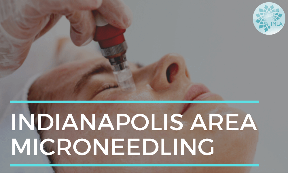 Indianapolis Area Microneedling