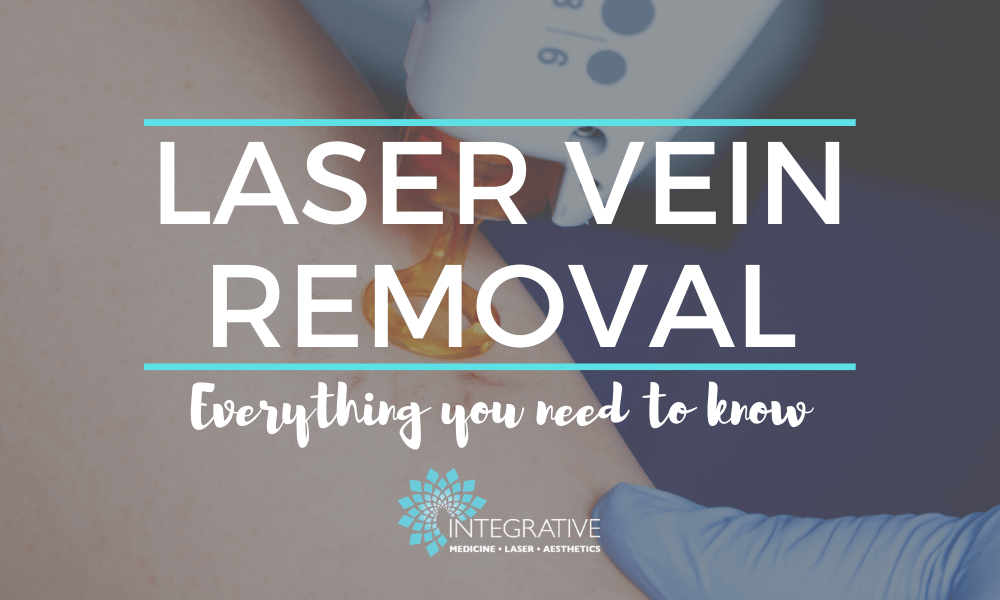 3 Things to Know About Laser Vein Removal in Indianapolis