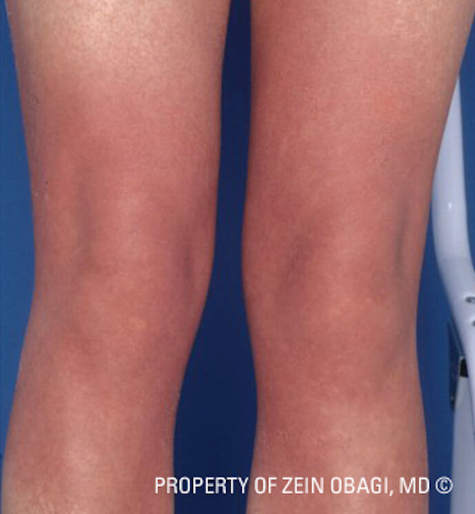 How To Get Rid Of Scars On Legs - Effective Treatment Options - Glowwis  Aesthetic Medical Aesthetics