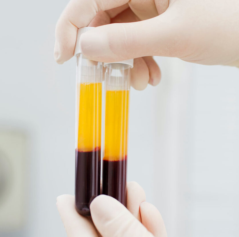 Platelet Rich Plasma (PRP)