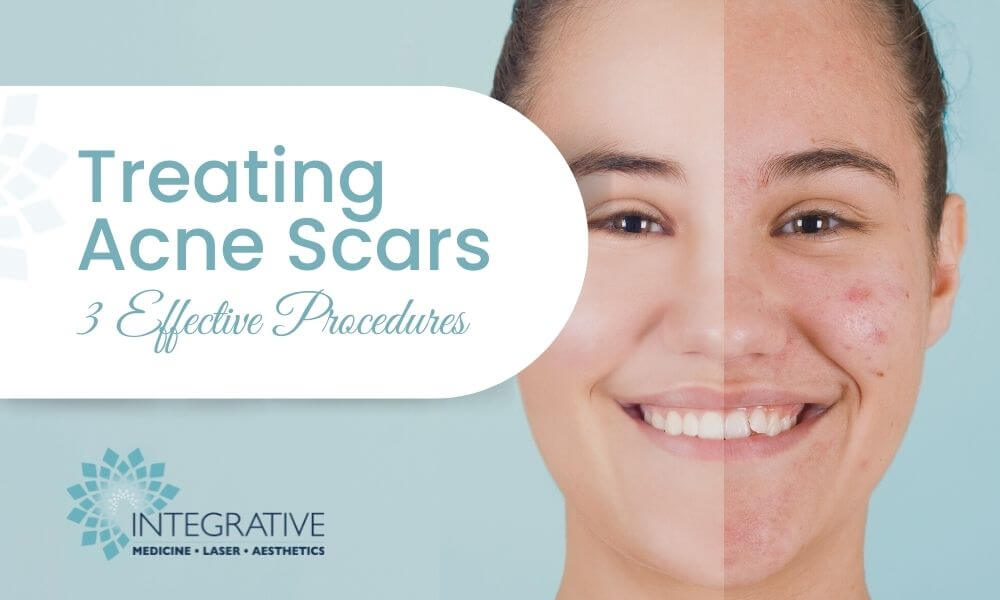 face scars from acne