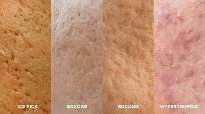 rolling acne scars