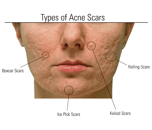 bacne scars treatment